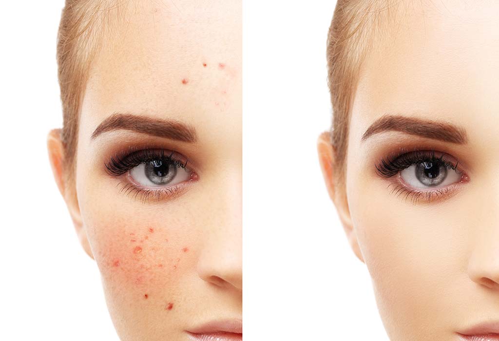 Facial Hyperpigmentation - Blog | Hair O Craft | Best FUE Hair ...