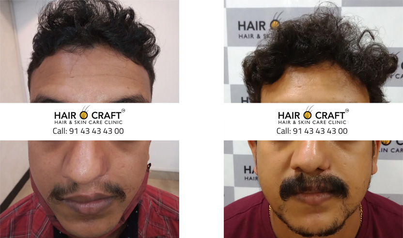 5. Natural-Looking Hair Transplant for Fine Blonde Hair - wide 9