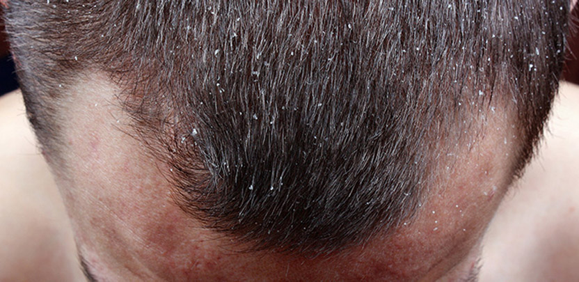 Safe Hair transplant methods | Natural looking Hair Transplant