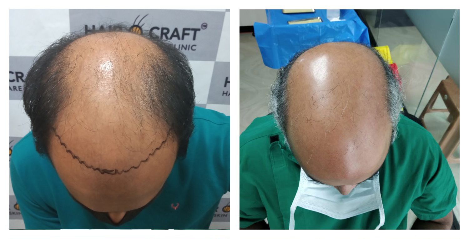 fueforyou Archives - Blog | Hair O Craft | Best FUE Hair Transplant Kerala