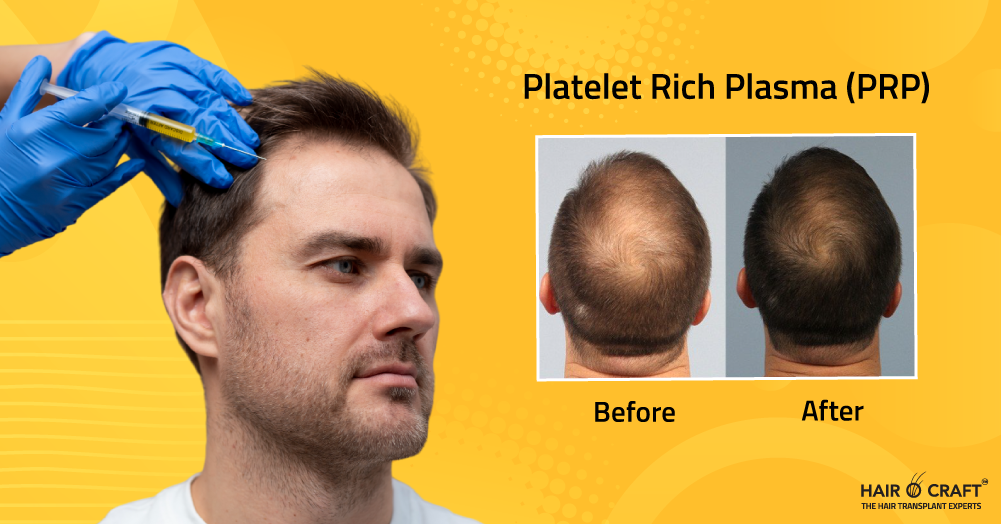 1 hair transplant clinic  Hair O Craft in Coimbatore India
