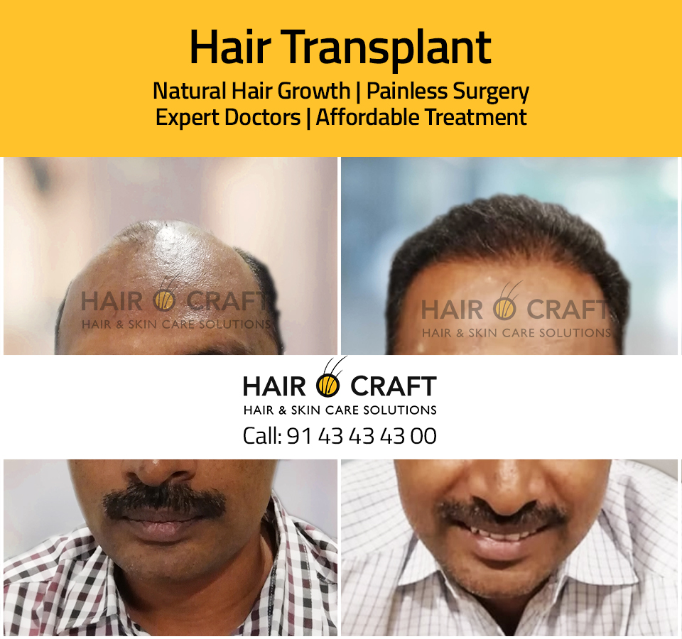 Hair O Craft Hair Transplant Clinic Kozhikode in Malaparamba,Kozhikode -  Best Hair Transplant Clinics in Kozhikode - Justdial