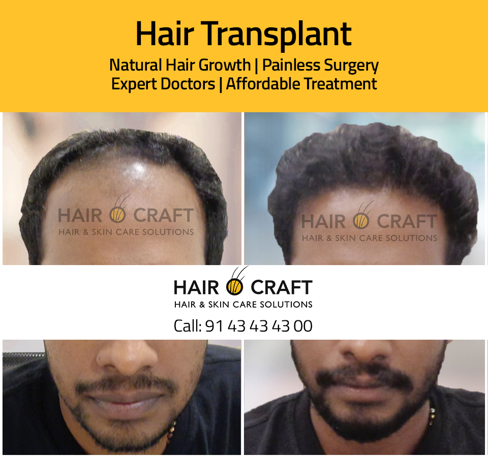 ഏതൊരു സാധാരണക്കാരനും താങ്ങാവുന്ന ചിലവേ ഹെയർ ട്രാൻസ്‌പ്ലാന്റഷന്  വരുന്നൊള്ളു..! @ Hair O Craft - YouTube