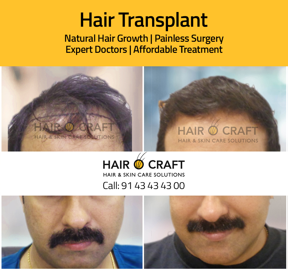 Hair Transplant Clinic | Before & After Of Hair Transplant | Result in Hair  Transplant | Hair O Craft