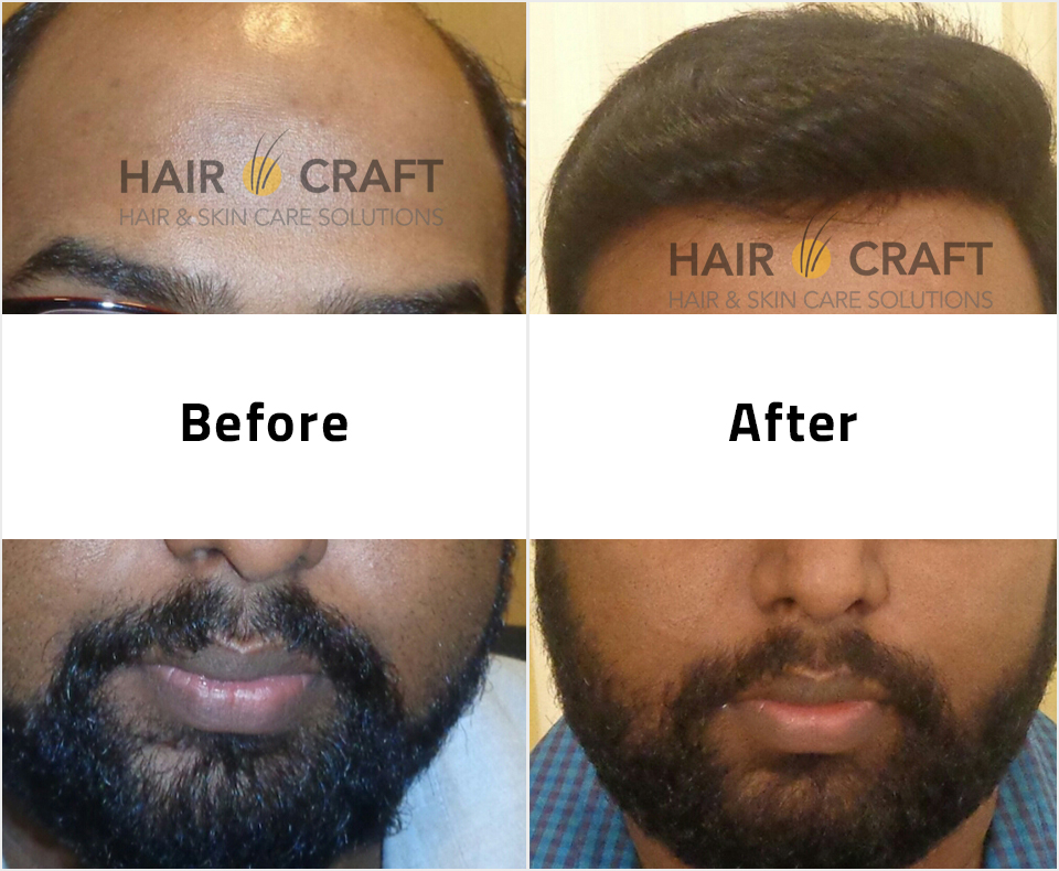 Hair Fixing Kerala | Before and After Gallery