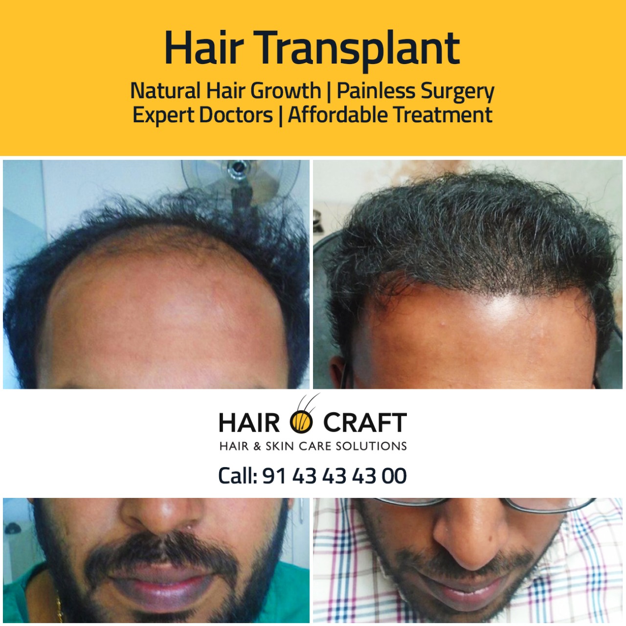 Hair Transplant in Bangalore  Best Results  Cost of Hair Transplant in  Bangalore  YouTube