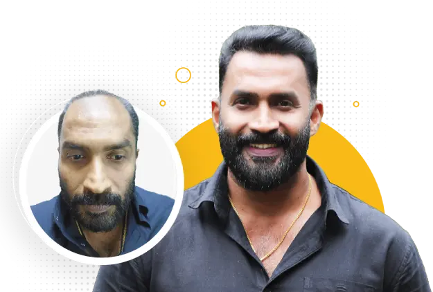 Best hair transplant in Kochi