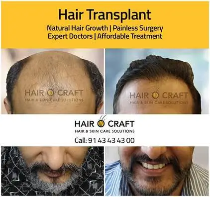 Best hair clinic in Kochi
