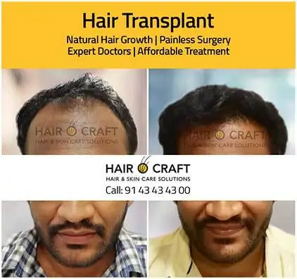 Hair treatment in Kochi 
