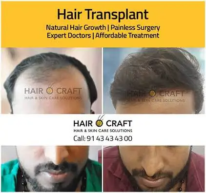 Best hair treatment in Kochi
