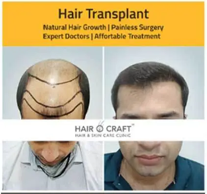 Hair transplant result in Kochi
