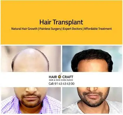 Hair restoration in Kochi