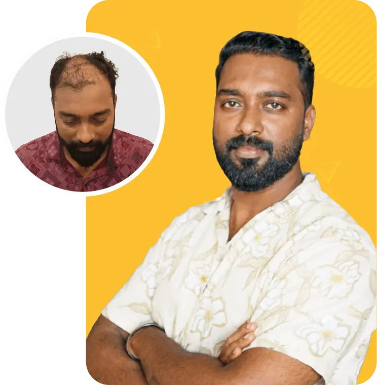 Best hair transplant in Kochi