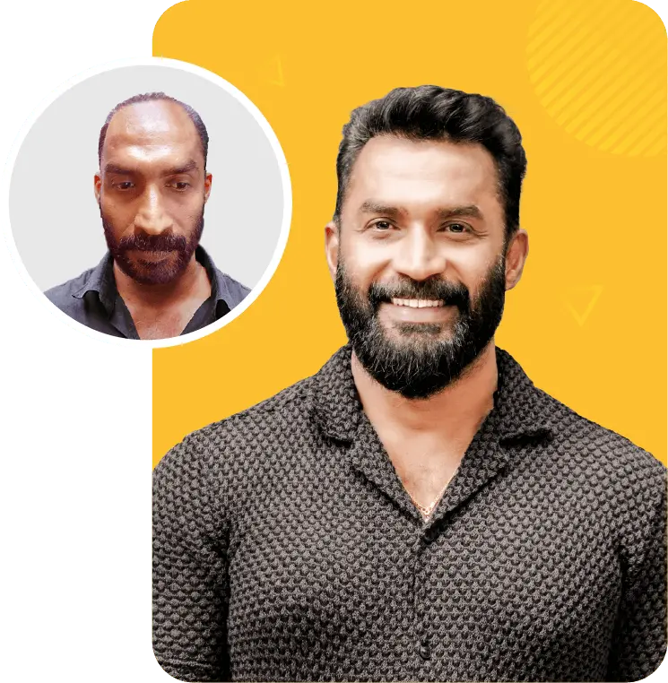 Best hair transplant in Kochi