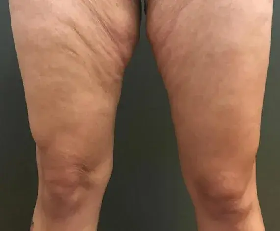 Why Consider a Thigh Lift?
