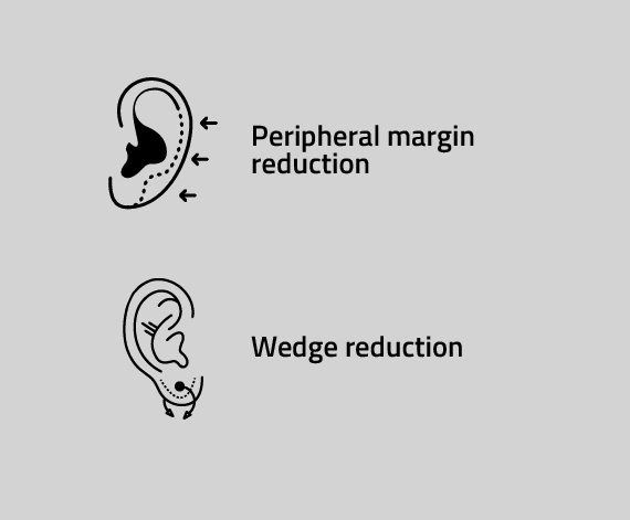 Types of Earlobe Repair