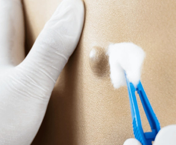 Safe and Scar-Minimizing Cyst Removal by Experts