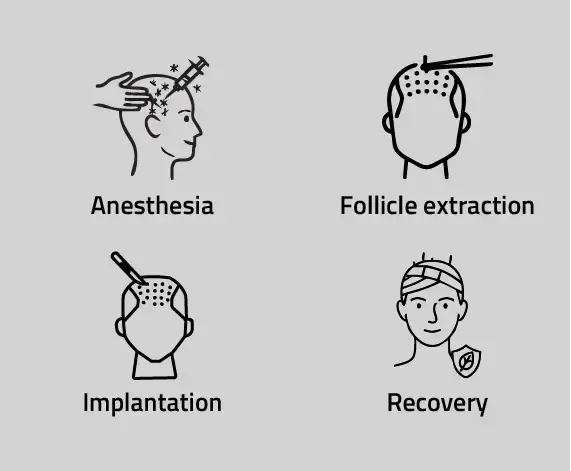 Needle Method Hair Transplant Procedure