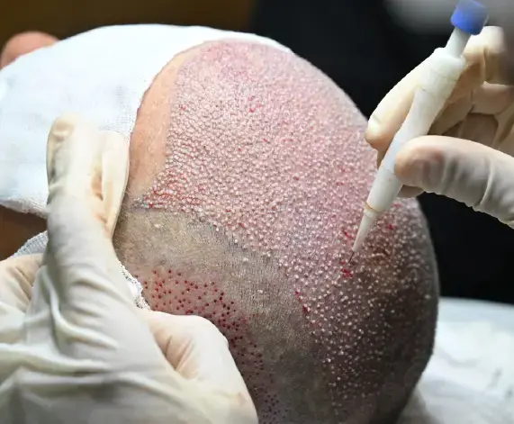 Pen Method Hair Transplant