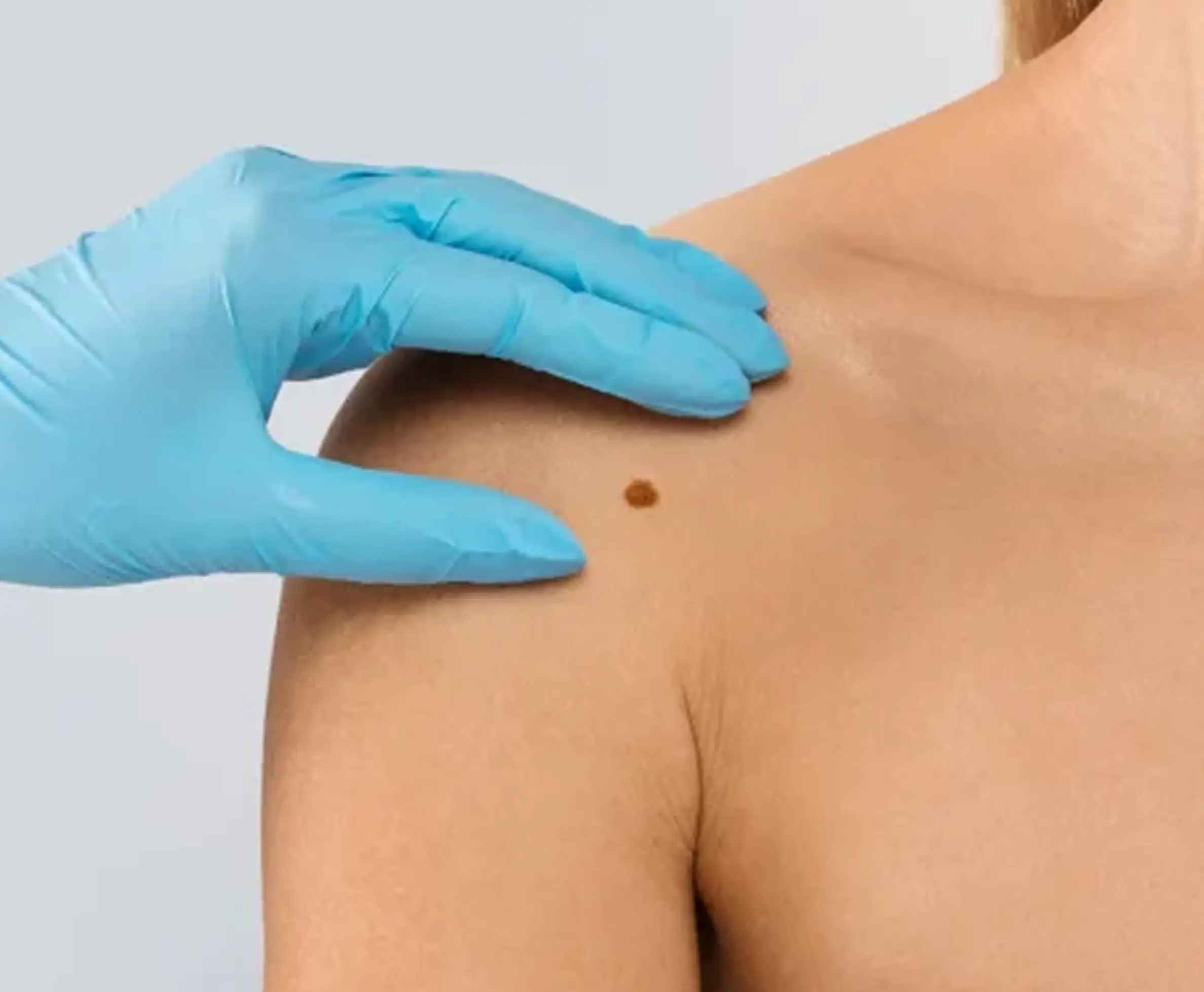 Why to Choose Warts & Skin Tag Removal Treatment?