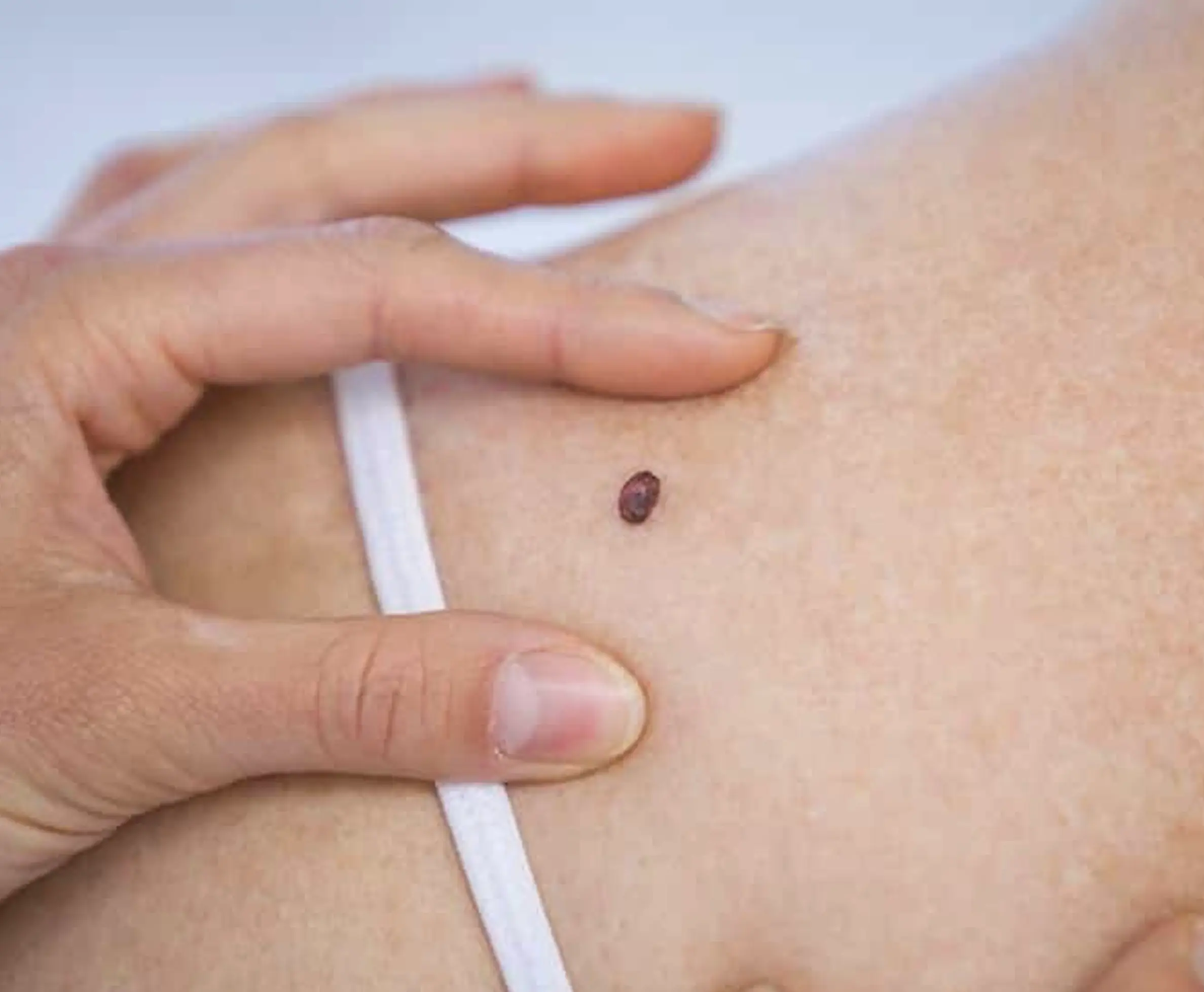 What is Mole Removal Treatment?