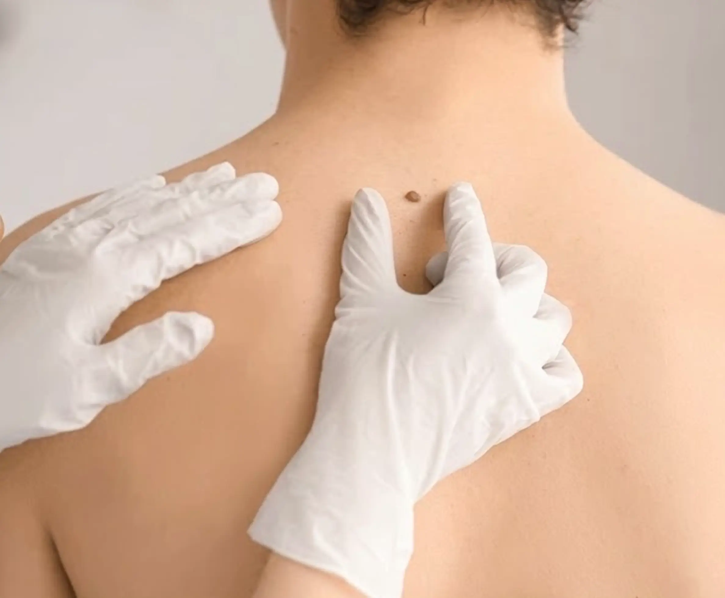  Benefits of Mole Removal