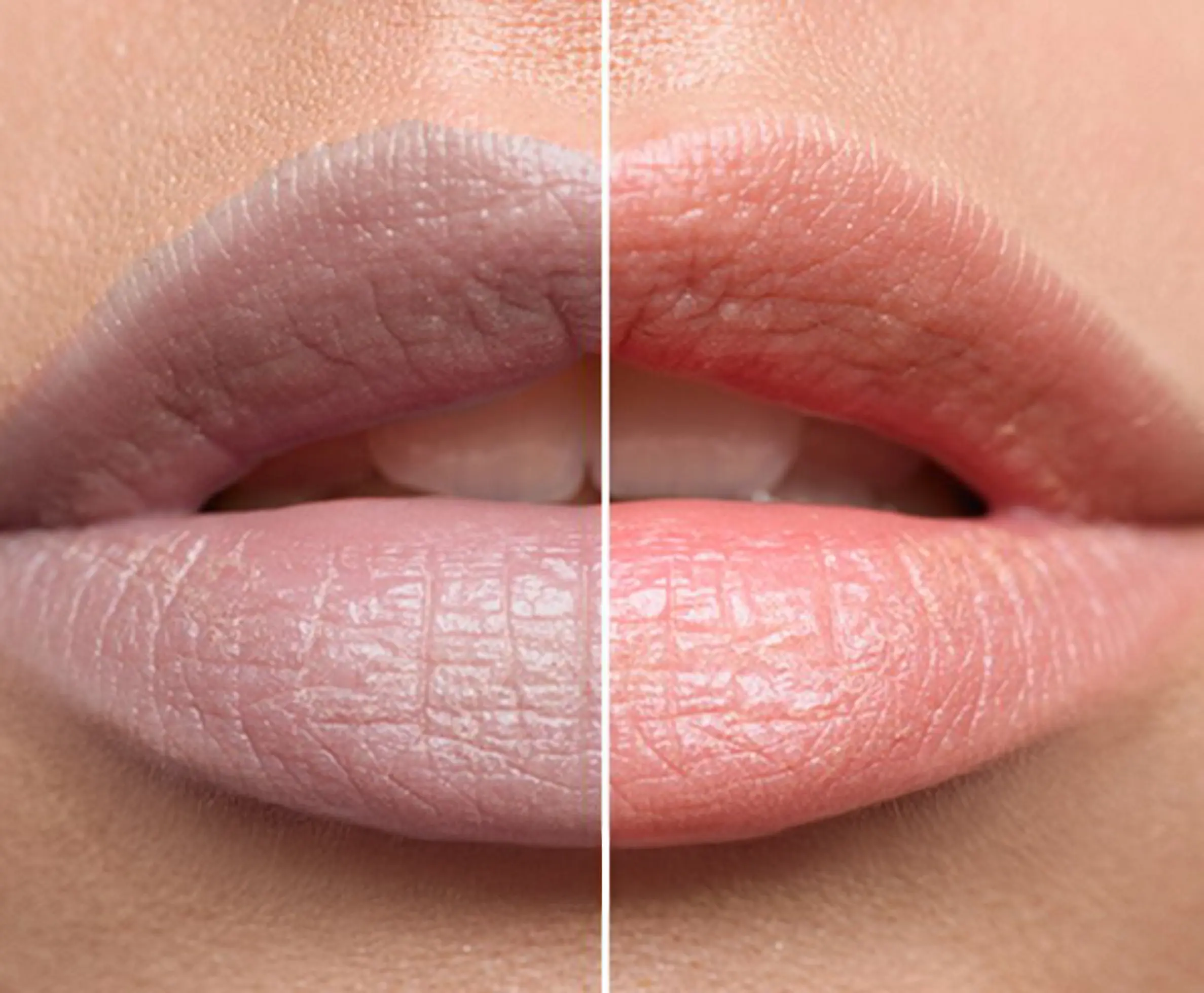 Why to Choose Lip Pigmentation Treatment?